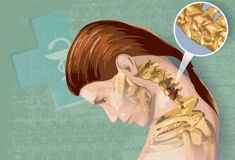 Osteokondrosis cervikoaren sintomak erreflexu