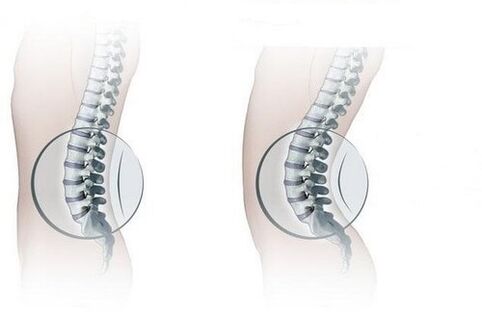 Bizkarrezurra normala eta lumbar lordosia areagotzea
